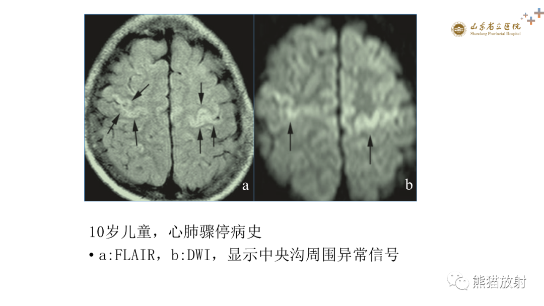 影像PPT - 【PPT】成人缺氧缺血性脑病影像学表现-21