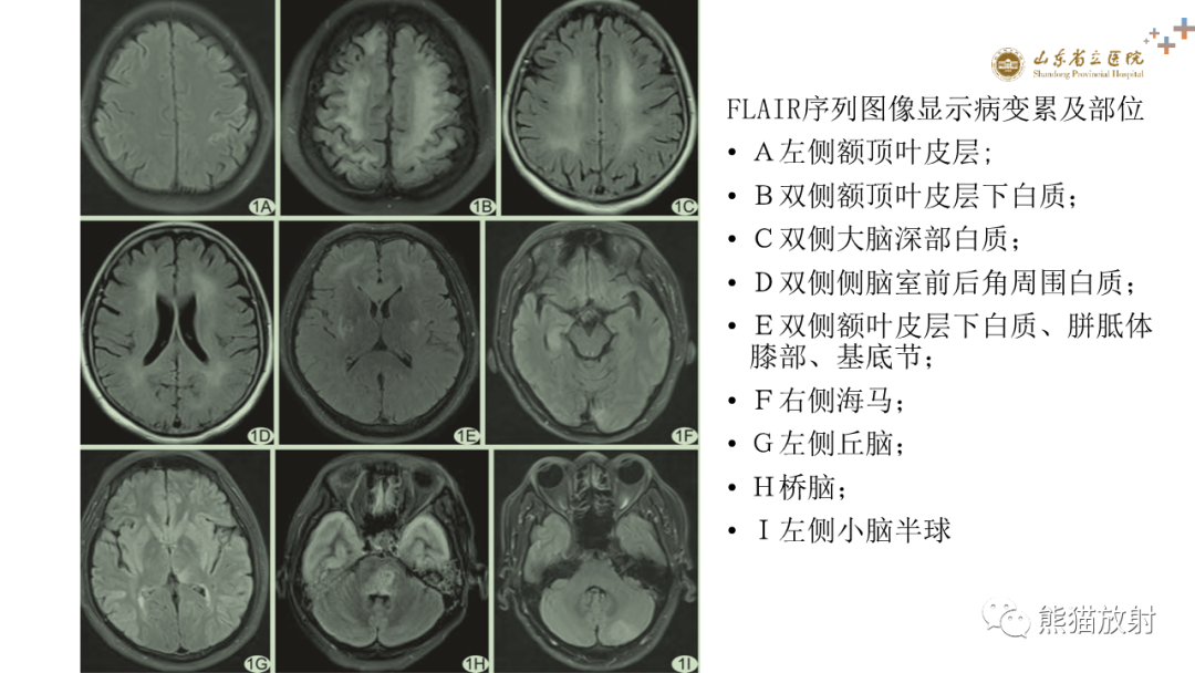影像PPT - 【PPT】成人缺氧缺血性脑病影像学表现-23