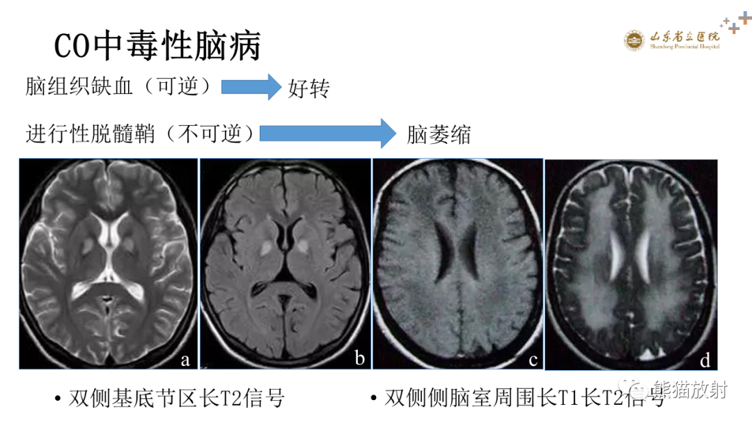 影像PPT - 【PPT】成人缺氧缺血性脑病影像学表现-30