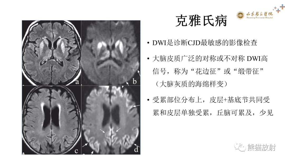 影像PPT - 【PPT】成人缺氧缺血性脑病影像学表现-32