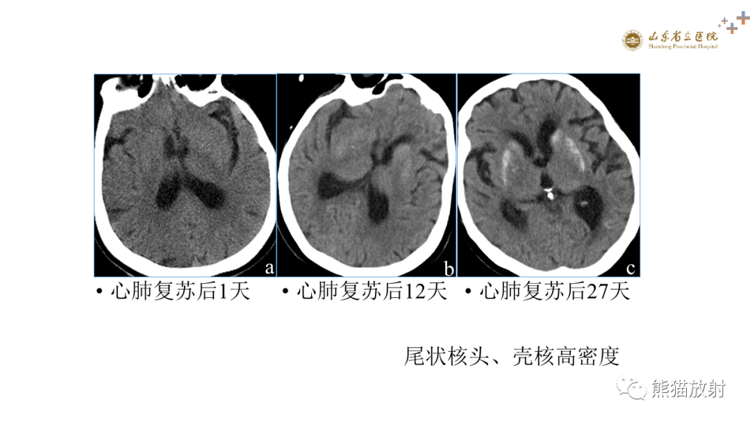 影像PPT - 【PPT】成人缺氧缺血性脑病影像学表现-35