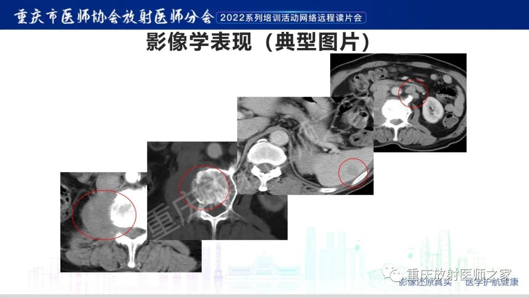 影像PPT - 【病例】肾脏淋巴瘤1例CT影像-4