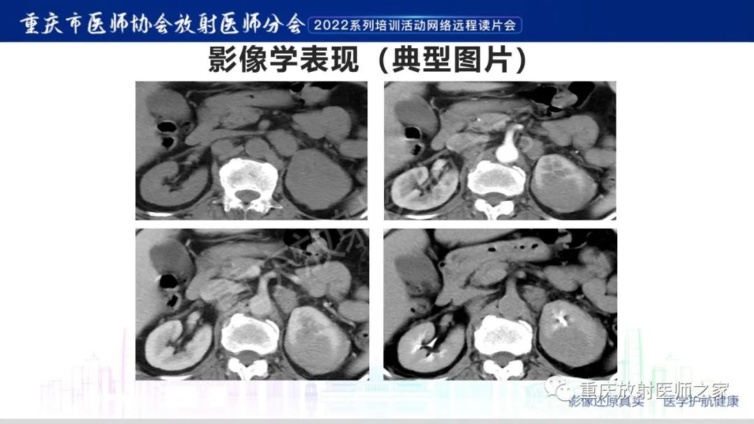 影像PPT - 【病例】肾脏淋巴瘤1例CT影像-3