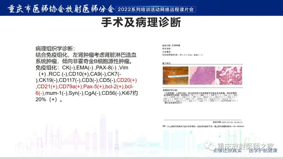 影像PPT - 【病例】肾脏淋巴瘤1例CT影像-7