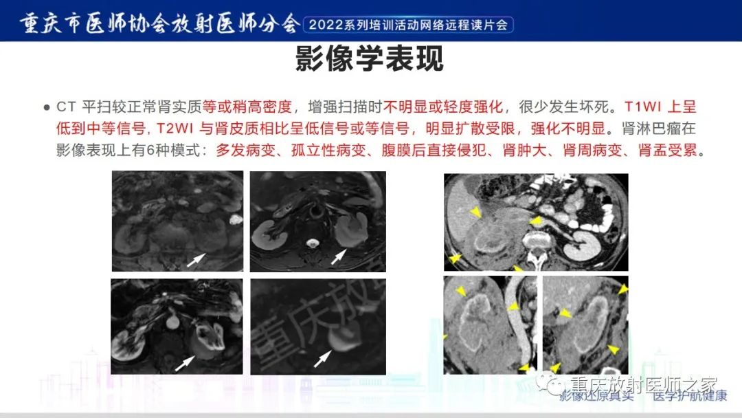 影像PPT - 【病例】肾脏淋巴瘤1例CT影像-10