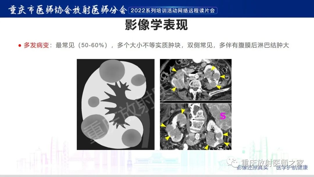 影像PPT - 【病例】肾脏淋巴瘤1例CT影像-11