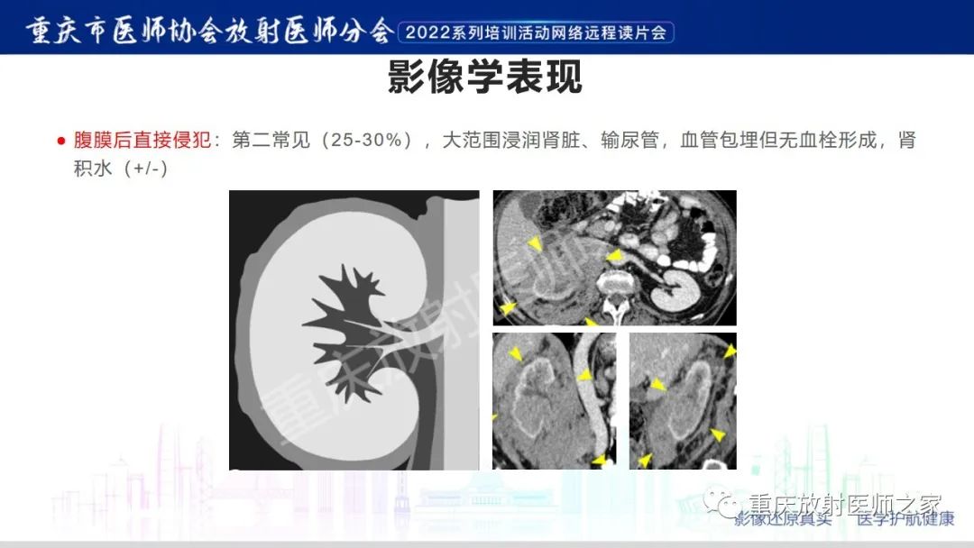 影像PPT - 【病例】肾脏淋巴瘤1例CT影像-13