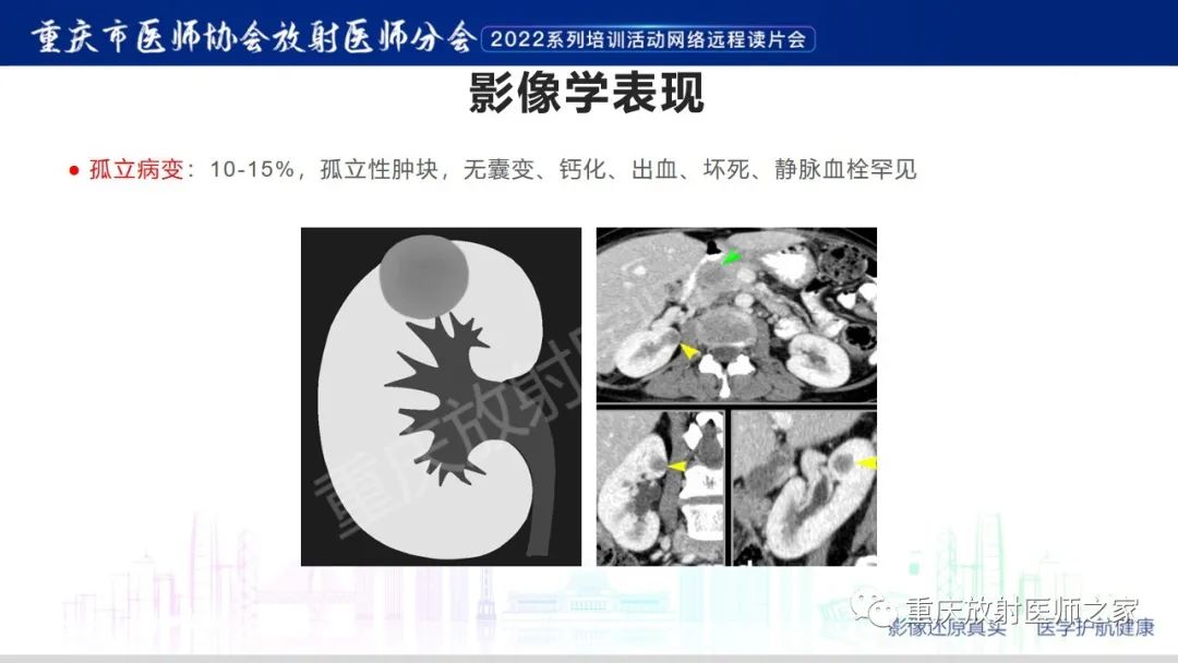 影像PPT - 【病例】肾脏淋巴瘤1例CT影像-12