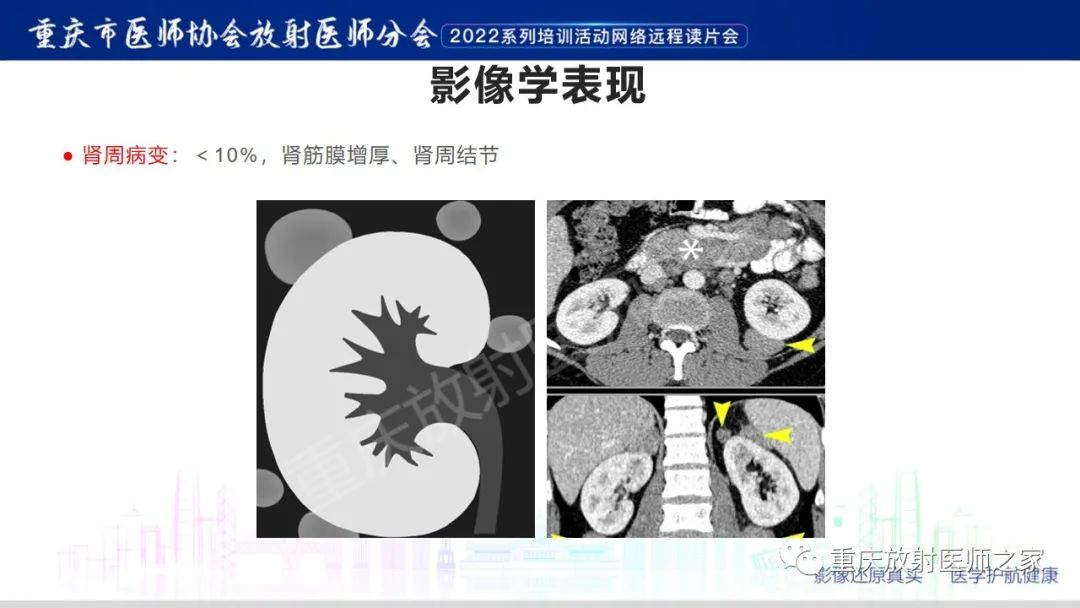 影像PPT - 【病例】肾脏淋巴瘤1例CT影像-14