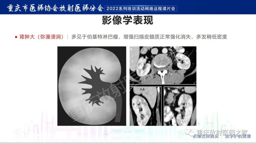 影像PPT - 【病例】肾脏淋巴瘤1例CT影像-15