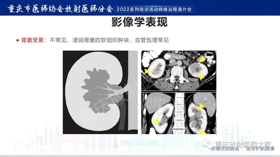 影像PPT - 【病例】肾脏淋巴瘤1例CT影像-16