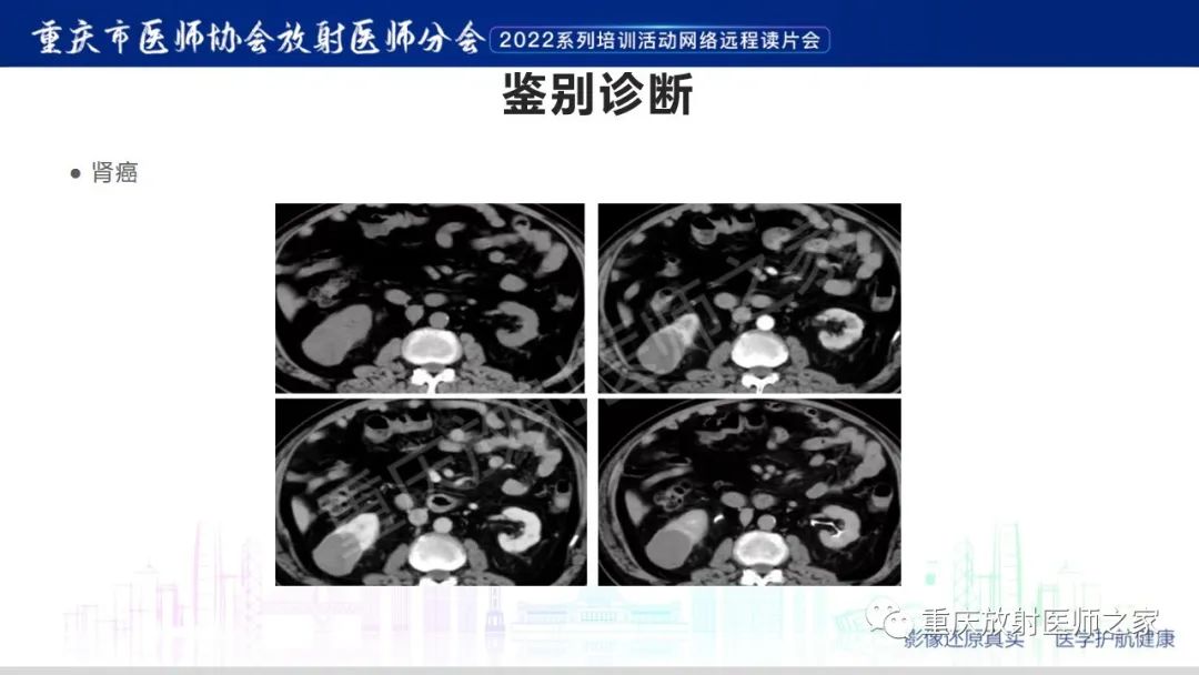 影像PPT - 【病例】肾脏淋巴瘤1例CT影像-18