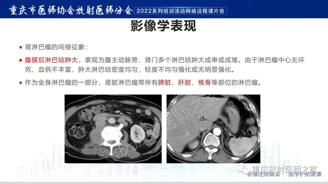 影像PPT - 【病例】肾脏淋巴瘤1例CT影像-17
