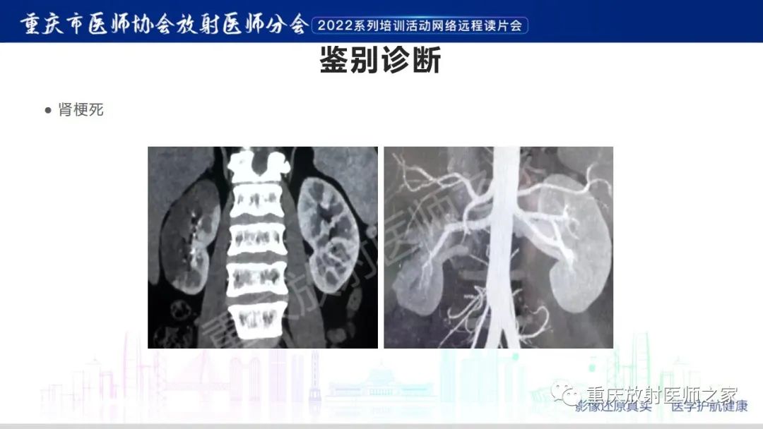 影像PPT - 【病例】肾脏淋巴瘤1例CT影像-19