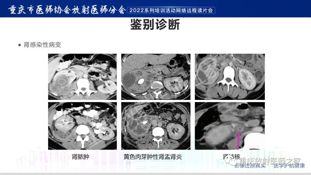 影像PPT - 【病例】肾脏淋巴瘤1例CT影像-20