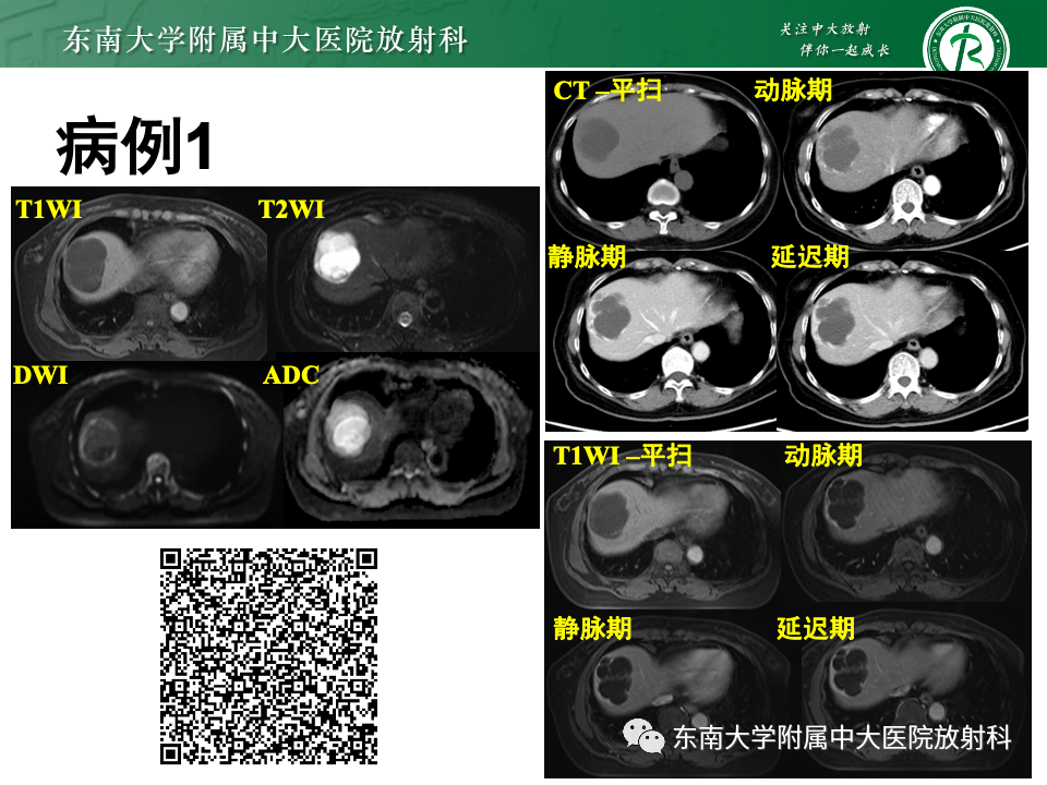 影像PPT - 【PPT】肝内多房囊性占位病例随访-2
