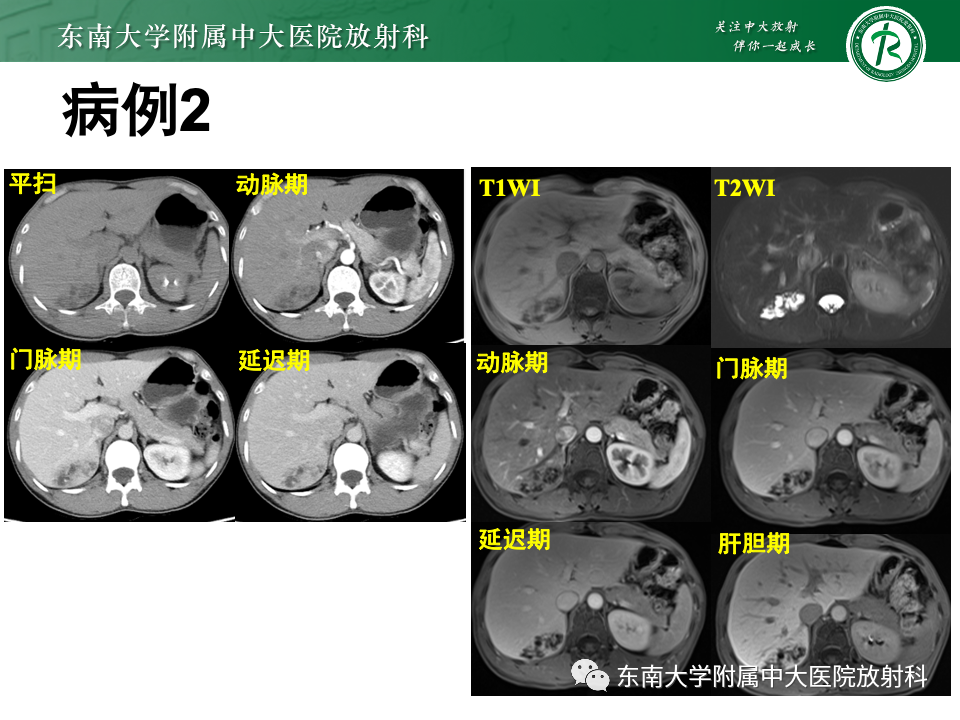 影像PPT - 【PPT】肝内多房囊性占位病例随访-4