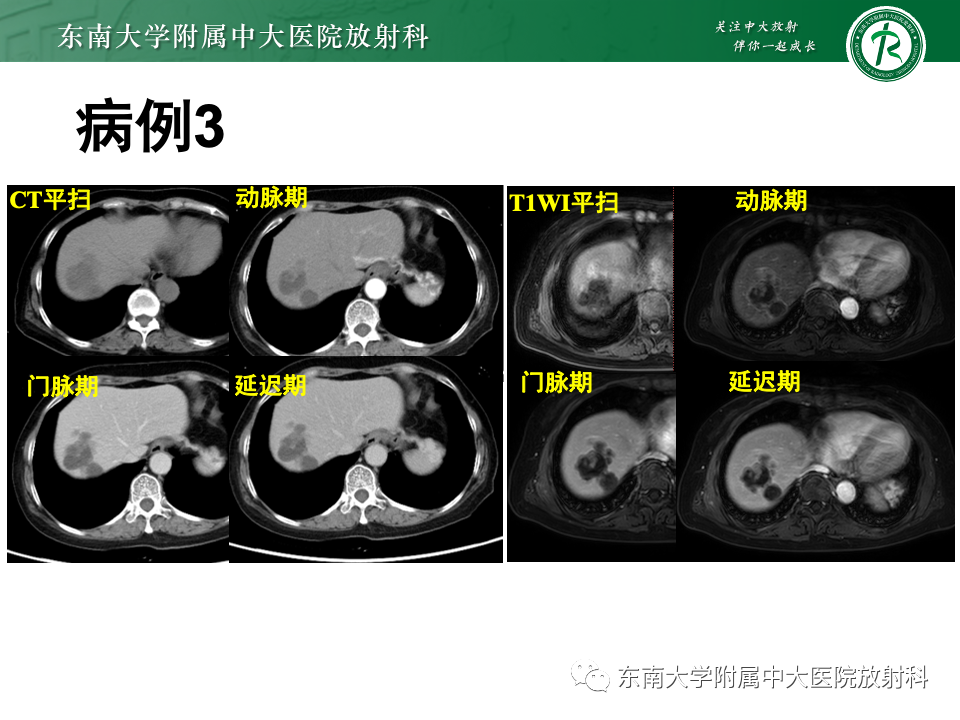 影像PPT - 【PPT】肝内多房囊性占位病例随访-6