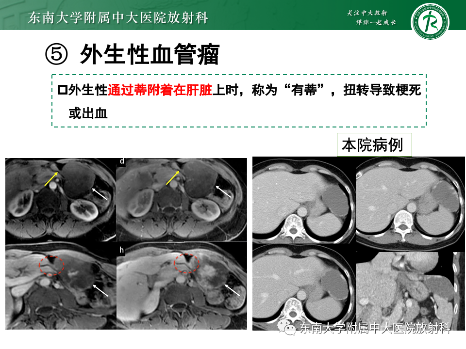 影像PPT - 【PPT】肝内多房囊性占位病例随访-20