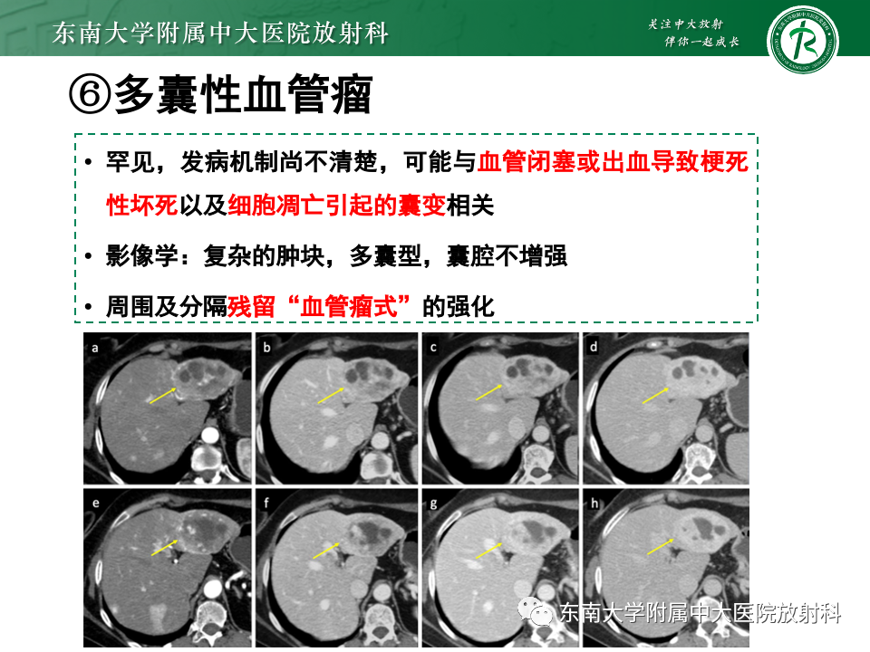 影像PPT - 【PPT】肝内多房囊性占位病例随访-21