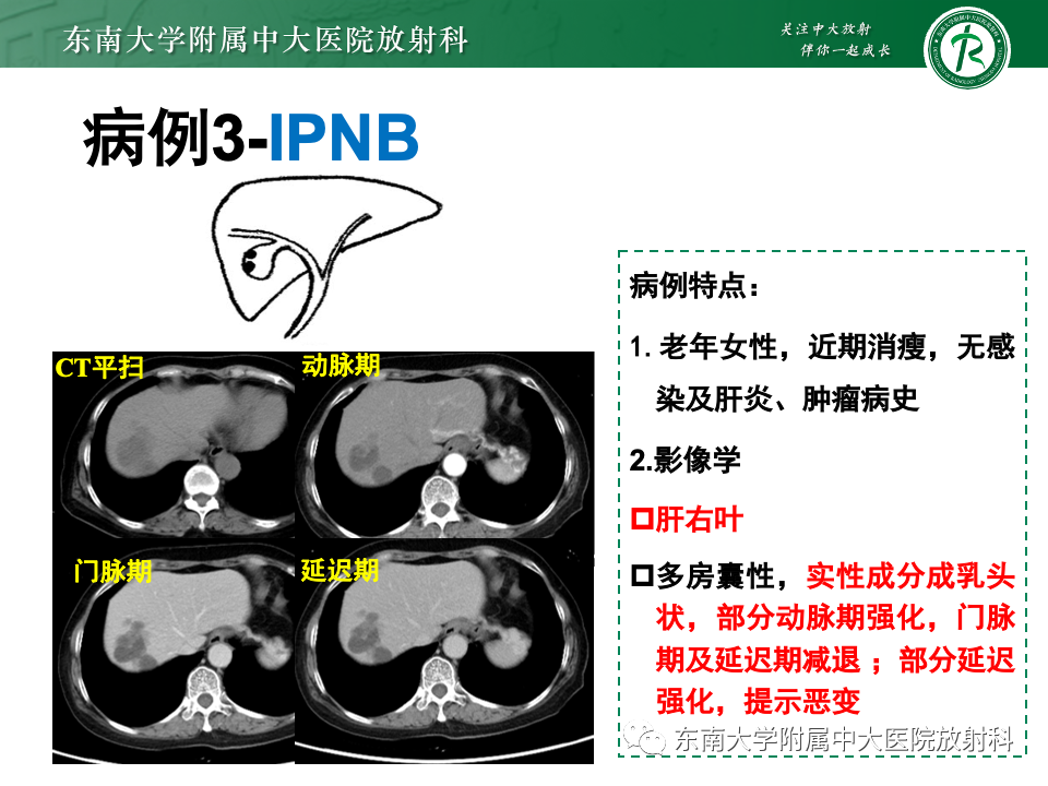 影像PPT - 【PPT】肝内多房囊性占位病例随访-30