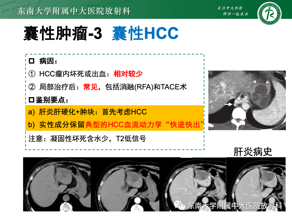 影像PPT - 【PPT】肝内多房囊性占位病例随访-33