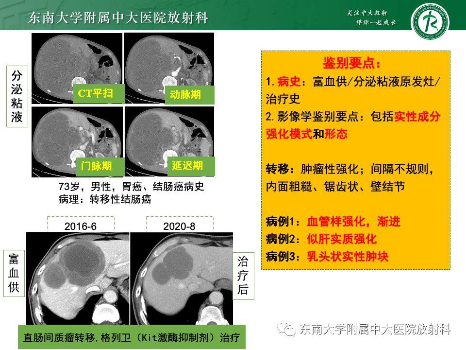 影像PPT - 【PPT】肝内多房囊性占位病例随访-35