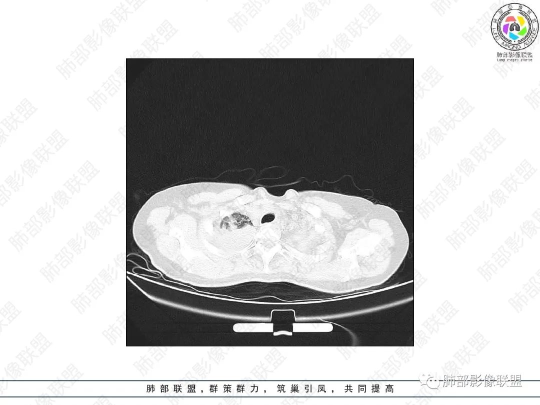 影像PPT - 【病例】变应性支气管肺曲霉病ABPA一例CT影像-3 影像PPT - 【病例】变应性支气管肺曲霉病ABPA一例CT影像-3