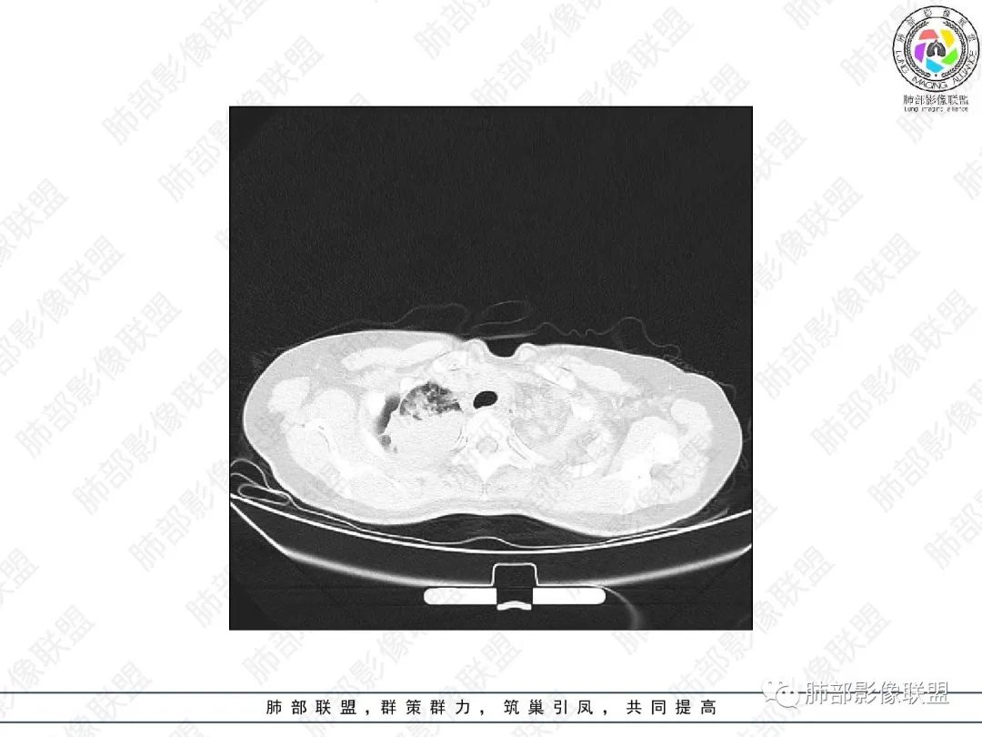 影像PPT - 【病例】变应性支气管肺曲霉病ABPA一例CT影像-4 影像PPT - 【病例】变应性支气管肺曲霉病ABPA一例CT影像-4