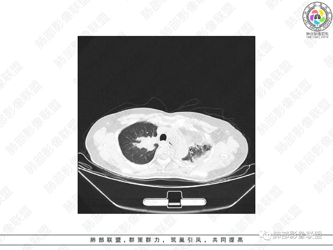影像PPT - 【病例】变应性支气管肺曲霉病ABPA一例CT影像-10 影像PPT - 【病例】变应性支气管肺曲霉病ABPA一例CT影像-10