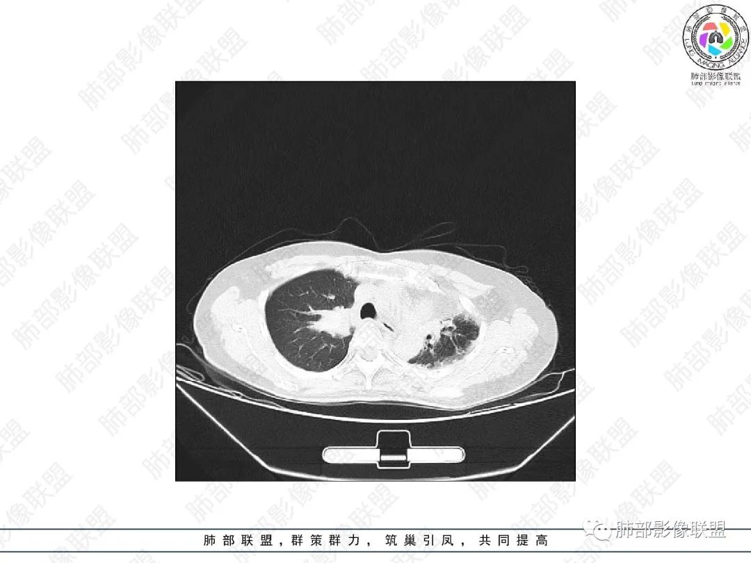 影像PPT - 【病例】变应性支气管肺曲霉病ABPA一例CT影像-11 影像PPT - 【病例】变应性支气管肺曲霉病ABPA一例CT影像-11