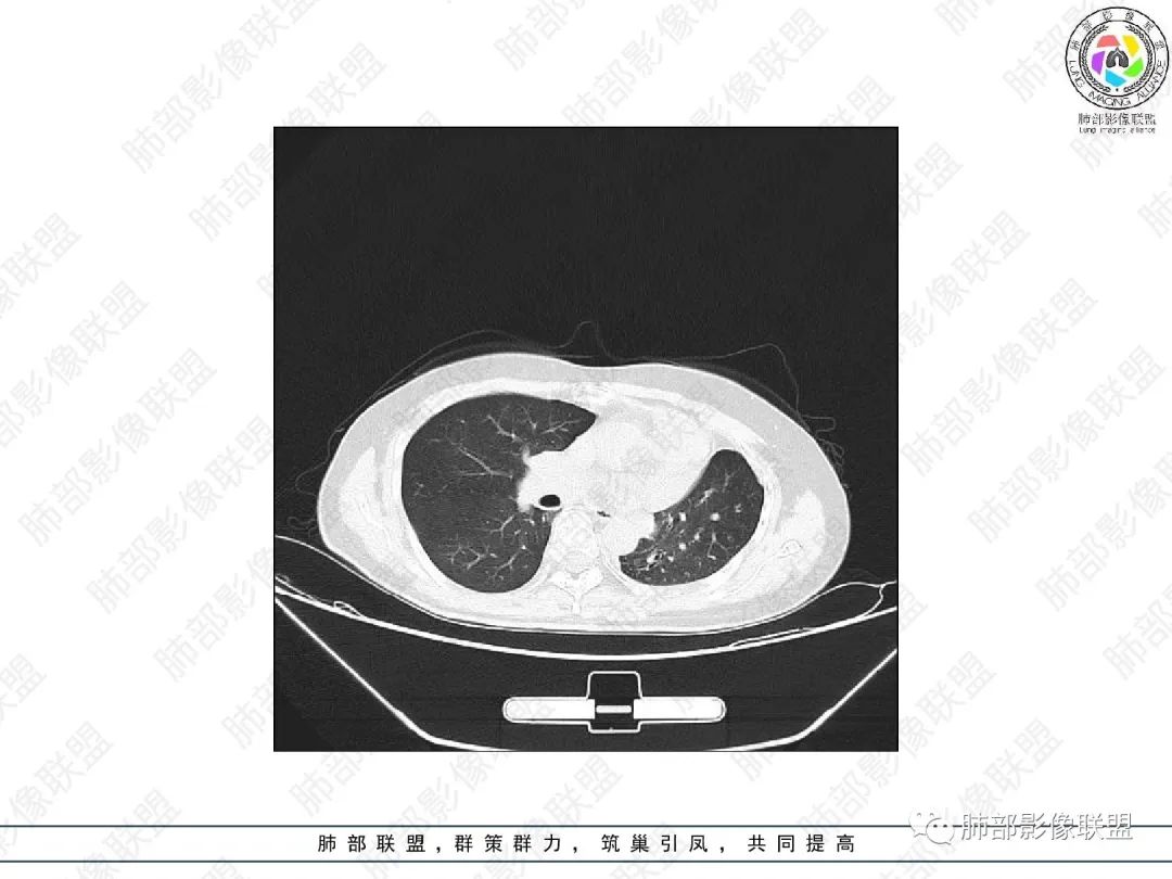 影像PPT - 【病例】变应性支气管肺曲霉病ABPA一例CT影像-17 影像PPT - 【病例】变应性支气管肺曲霉病ABPA一例CT影像-17