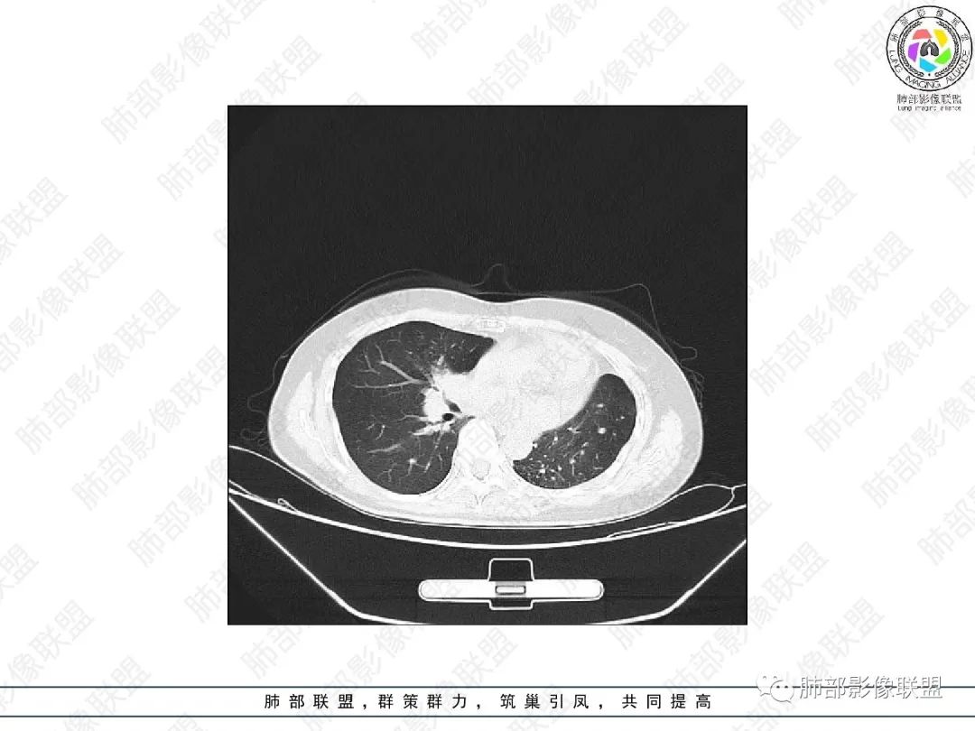 影像PPT - 【病例】变应性支气管肺曲霉病ABPA一例CT影像-18 影像PPT - 【病例】变应性支气管肺曲霉病ABPA一例CT影像-18