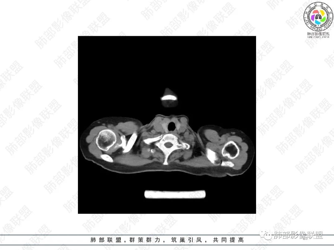 影像PPT - 【病例】变应性支气管肺曲霉病ABPA一例CT影像-25 影像PPT - 【病例】变应性支气管肺曲霉病ABPA一例CT影像-25