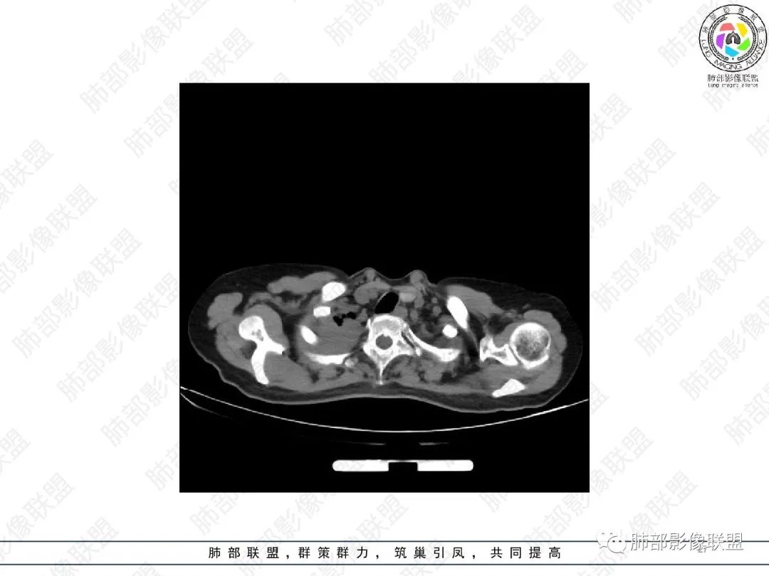 影像PPT - 【病例】变应性支气管肺曲霉病ABPA一例CT影像-27 影像PPT - 【病例】变应性支气管肺曲霉病ABPA一例CT影像-27