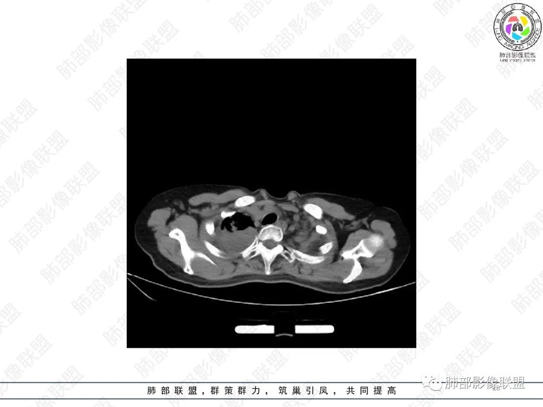 影像PPT - 【病例】变应性支气管肺曲霉病ABPA一例CT影像-28 影像PPT - 【病例】变应性支气管肺曲霉病ABPA一例CT影像-28
