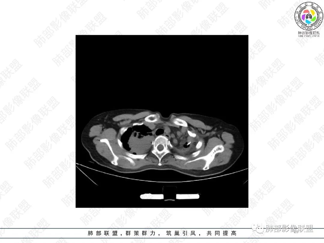 影像PPT - 【病例】变应性支气管肺曲霉病ABPA一例CT影像-29 影像PPT - 【病例】变应性支气管肺曲霉病ABPA一例CT影像-29