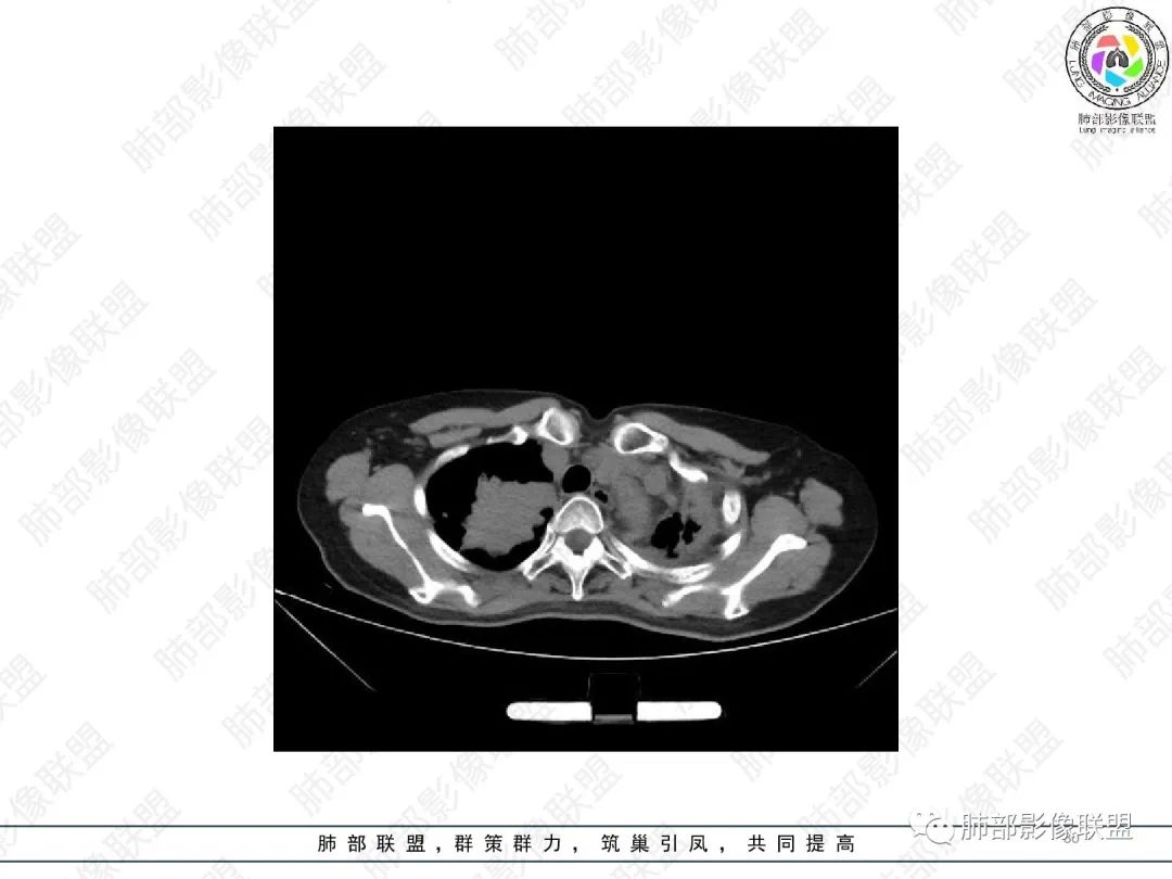 影像PPT - 【病例】变应性支气管肺曲霉病ABPA一例CT影像-30 影像PPT - 【病例】变应性支气管肺曲霉病ABPA一例CT影像-30