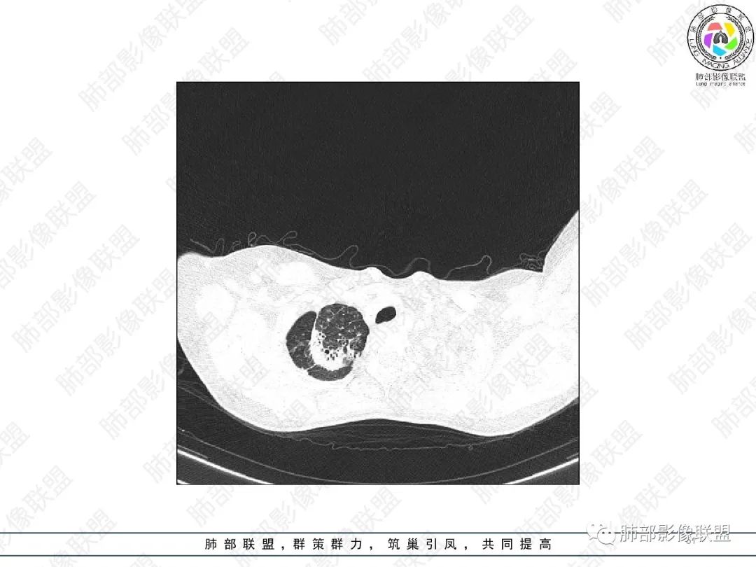 影像PPT - 【病例】变应性支气管肺曲霉病ABPA一例CT影像-50 影像PPT - 【病例】变应性支气管肺曲霉病ABPA一例CT影像-50