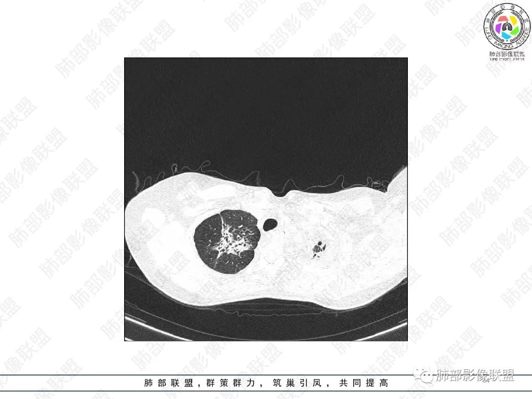 影像PPT - 【病例】变应性支气管肺曲霉病ABPA一例CT影像-53 影像PPT - 【病例】变应性支气管肺曲霉病ABPA一例CT影像-53
