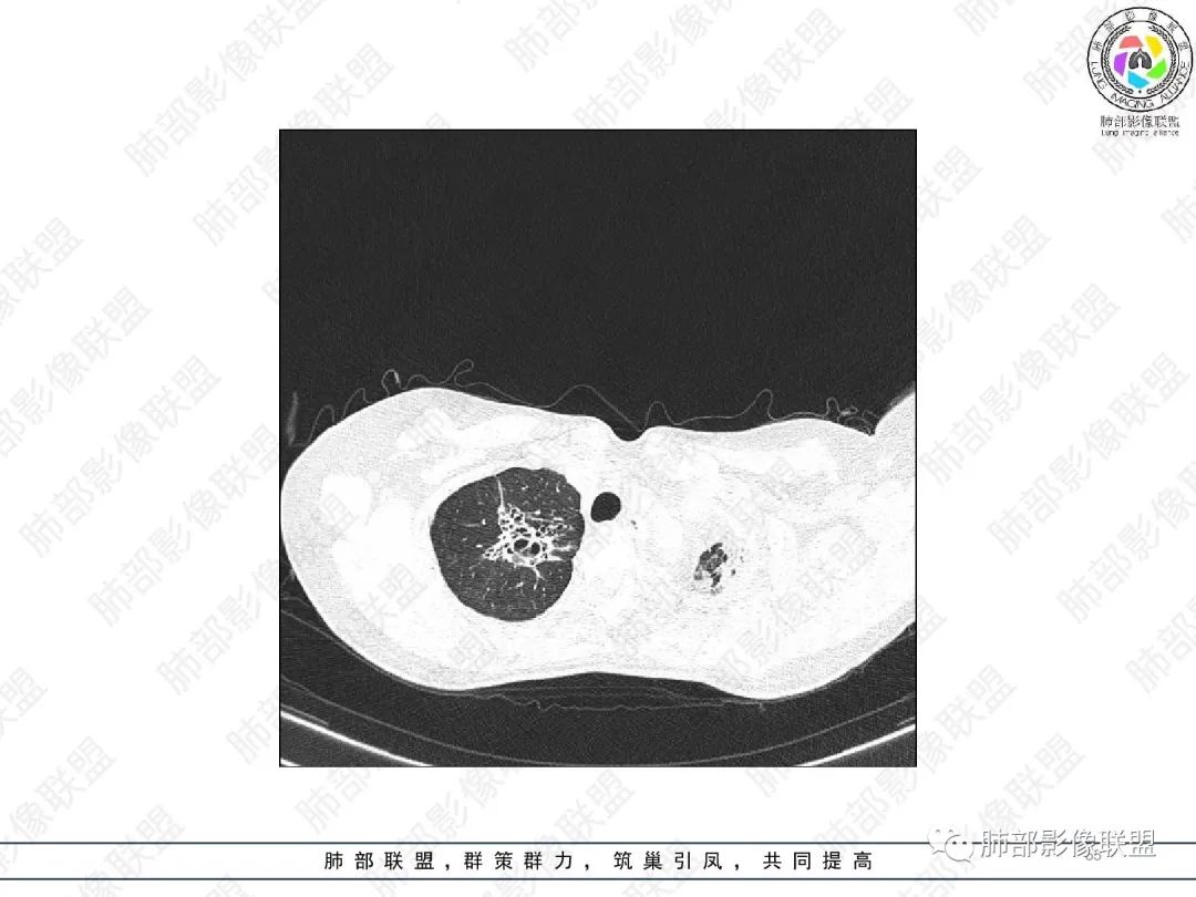 影像PPT - 【病例】变应性支气管肺曲霉病ABPA一例CT影像-54 影像PPT - 【病例】变应性支气管肺曲霉病ABPA一例CT影像-54