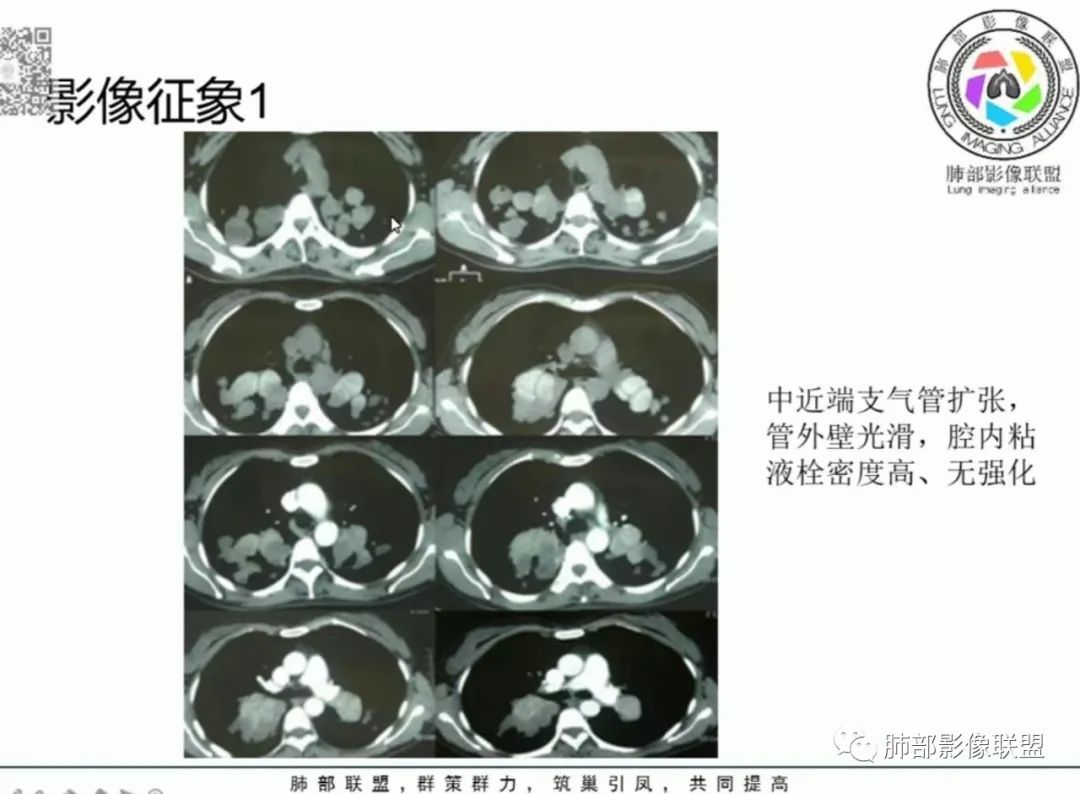 影像PPT - 【病例】变应性支气管肺曲霉病ABPA一例CT影像-63 影像PPT - 【病例】变应性支气管肺曲霉病ABPA一例CT影像-63