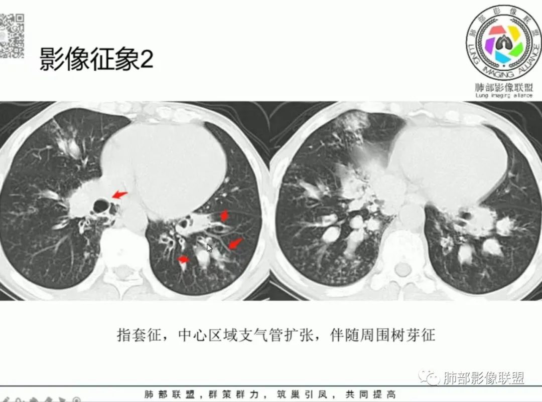 影像PPT - 【病例】变应性支气管肺曲霉病ABPA一例CT影像-64 影像PPT - 【病例】变应性支气管肺曲霉病ABPA一例CT影像-64