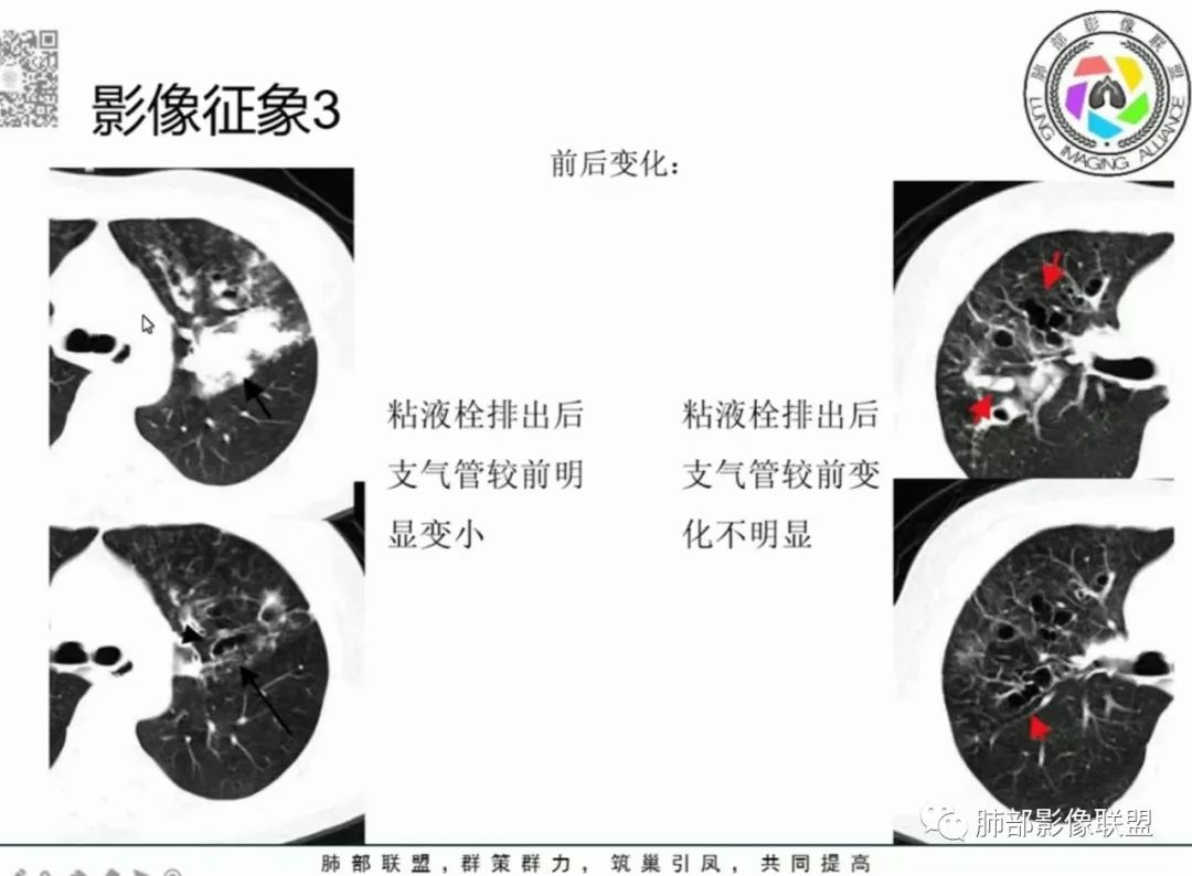 影像PPT - 【病例】变应性支气管肺曲霉病ABPA一例CT影像-65 影像PPT - 【病例】变应性支气管肺曲霉病ABPA一例CT影像-65
