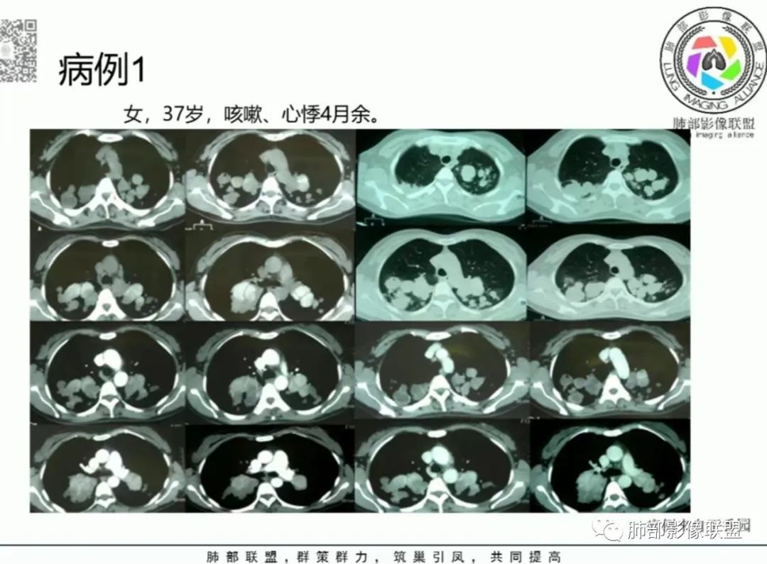 影像PPT - 【病例】变应性支气管肺曲霉病ABPA一例CT影像-66 影像PPT - 【病例】变应性支气管肺曲霉病ABPA一例CT影像-66