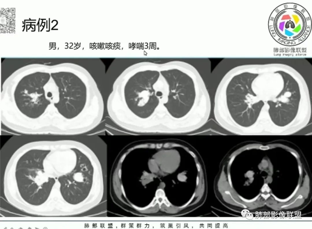 影像PPT - 【病例】变应性支气管肺曲霉病ABPA一例CT影像-67 影像PPT - 【病例】变应性支气管肺曲霉病ABPA一例CT影像-67
