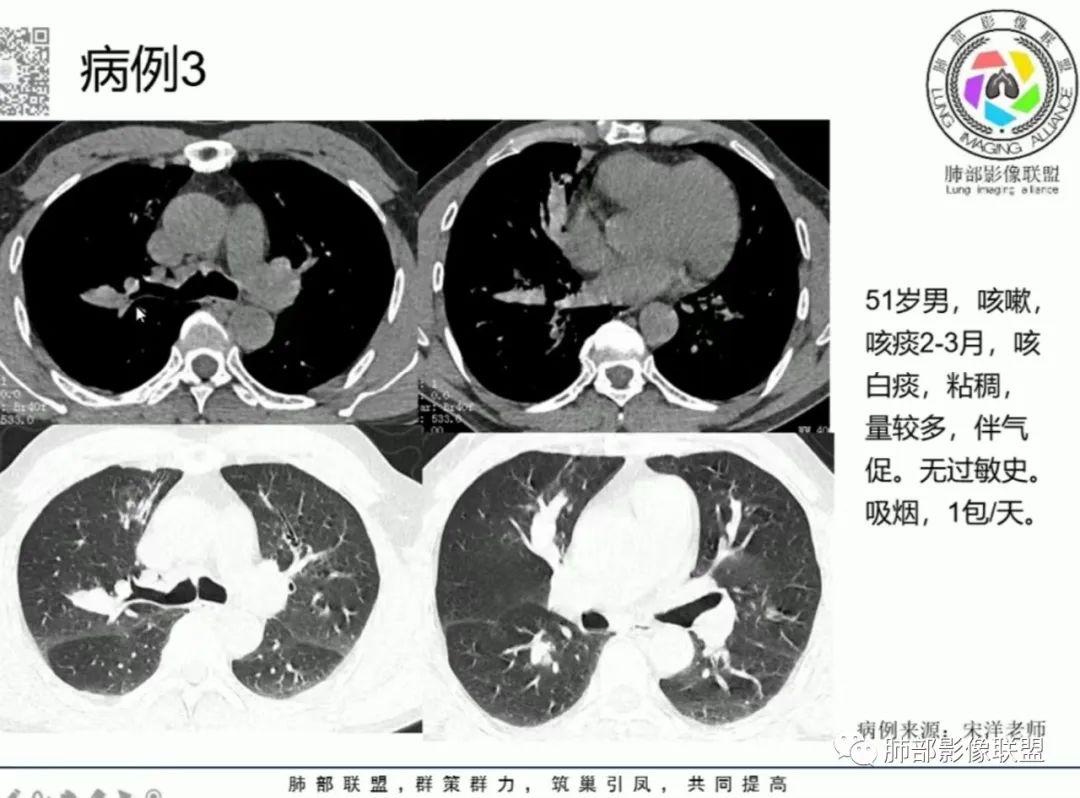 影像PPT - 【病例】变应性支气管肺曲霉病ABPA一例CT影像-68 影像PPT - 【病例】变应性支气管肺曲霉病ABPA一例CT影像-68