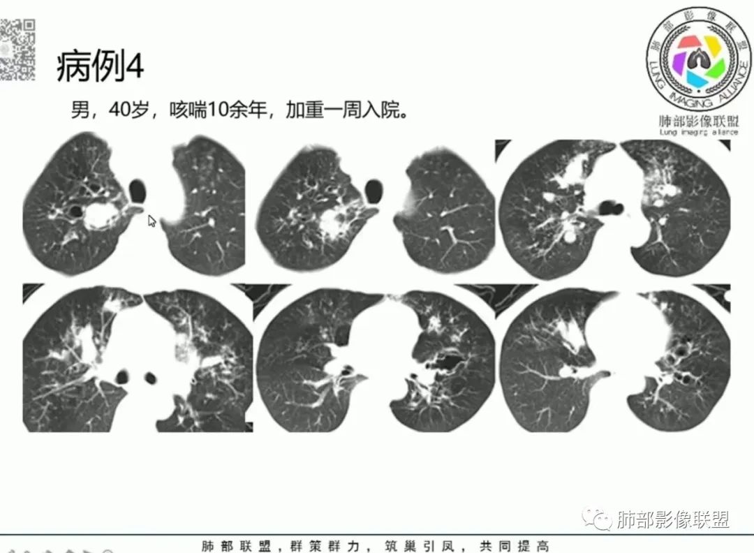 影像PPT - 【病例】变应性支气管肺曲霉病ABPA一例CT影像-69 影像PPT - 【病例】变应性支气管肺曲霉病ABPA一例CT影像-69