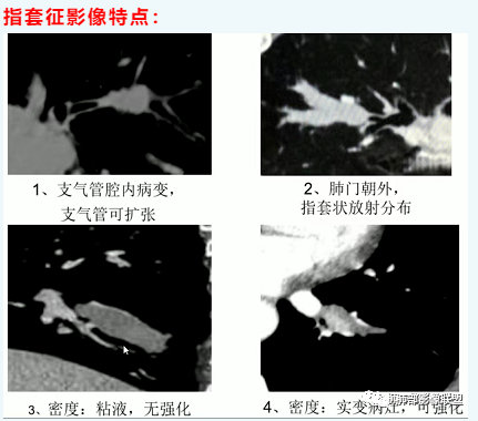 影像PPT - 【病例】变应性支气管肺曲霉病ABPA一例CT影像-70 影像PPT - 【病例】变应性支气管肺曲霉病ABPA一例CT影像-70
