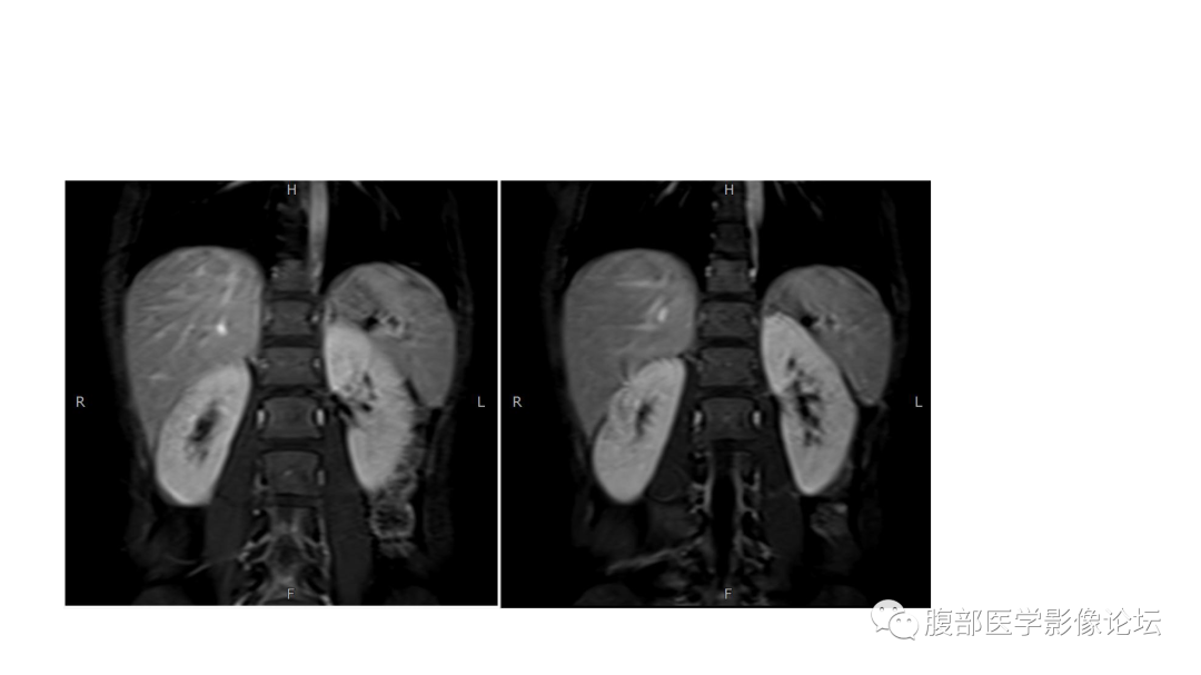 影像PPT - 【病例】肾脏黄色肉芽肿性肾盂肾炎1例CT及MR影像诊断-11